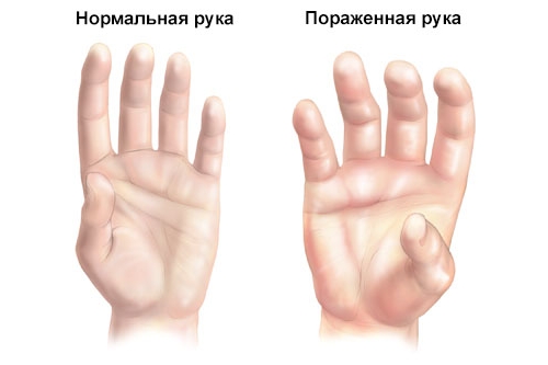 Синдром Зудека