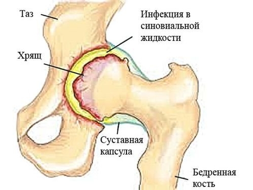 Синовит тазобедренного сустава