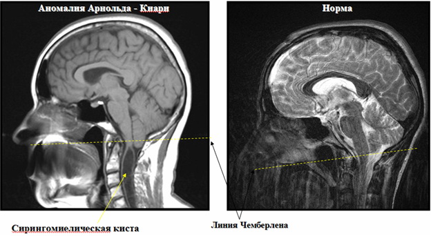 Сирингомиелическая киста