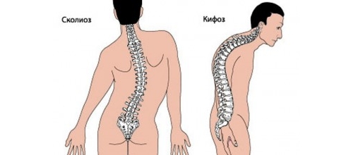 Сколиоз и кифоз