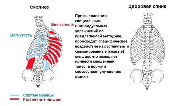 Сколиоз и мышечный дисбаланс