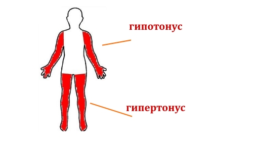 Смешанный тетрапарез