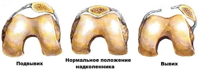 Смещение надколенника