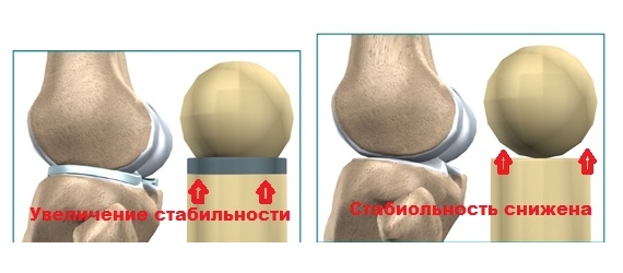 Снижение стабильности при отсутствии мениска