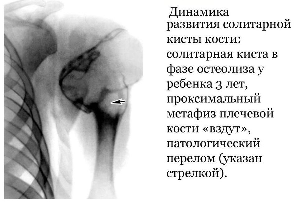 Солитарная костная киста