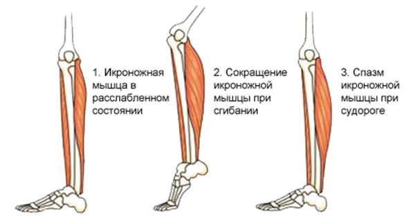 Спазм икроножной мышцы