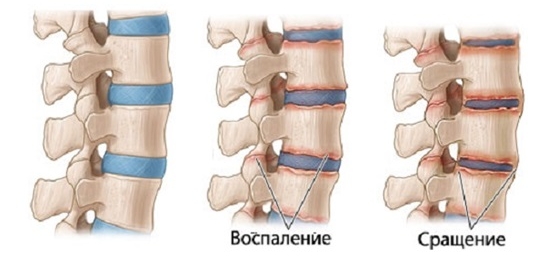 Костное заращение позвонков при спондилите