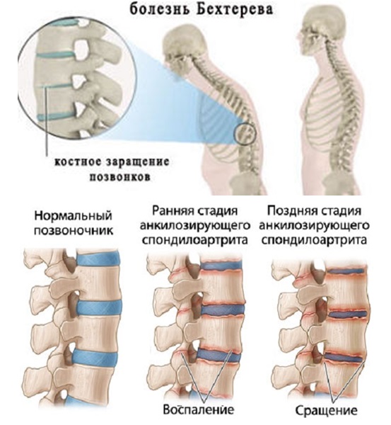 Спондилит — болезнь Бехтерева