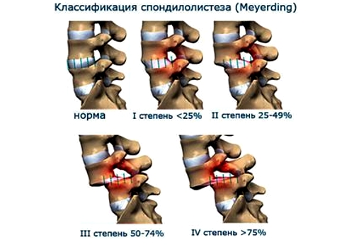 Виды спондилолистеза по Мейердингу