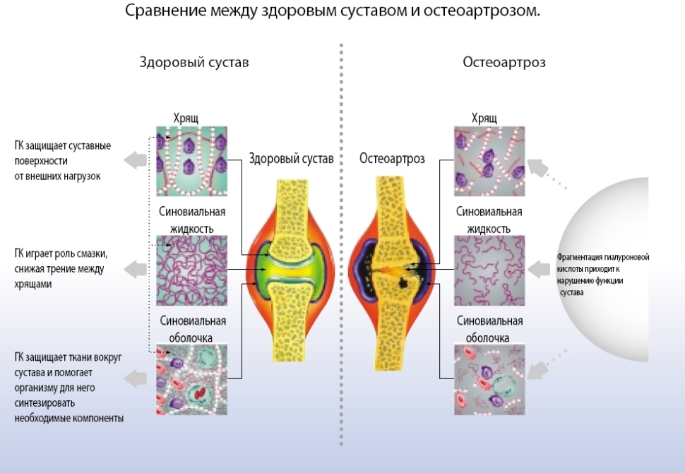 Срванение здорового сустава и остеоартроза