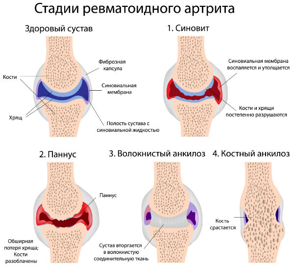 Стадии ревматоидного артрита