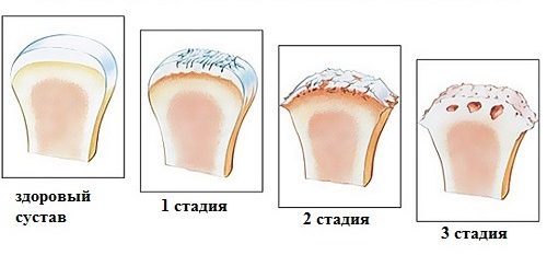 Стадии артроза