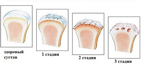 Стадии артроза