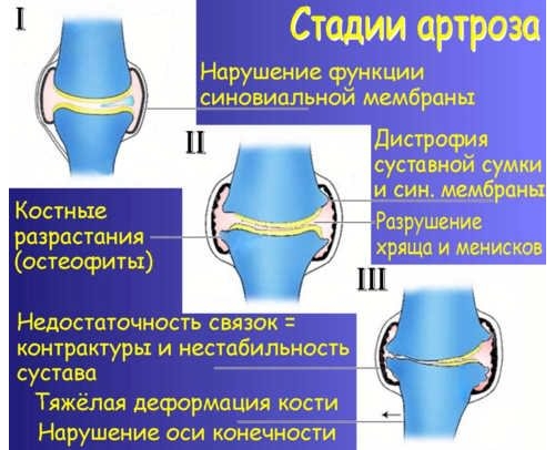 Стадии артроза
