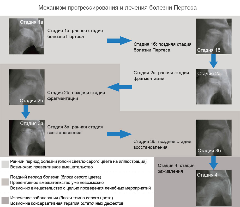 Стадии болезни Пертеса