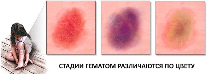 Стадии гематомы
