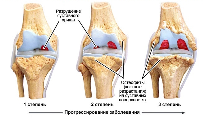 Стадии гонартроза