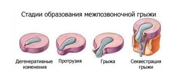 Стадии грыжи позвоночника