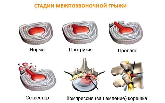 Стадии межпозвоночной грыжи