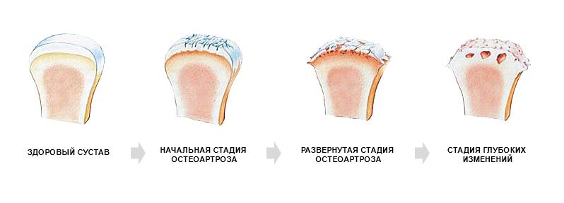 Стадии артроза