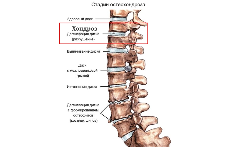 Стадии остеохондроза