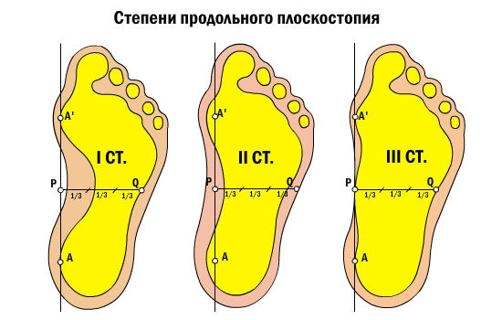 Стадии продольного плоскостопия