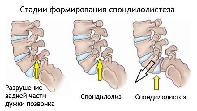 Стадии спондилолистеза