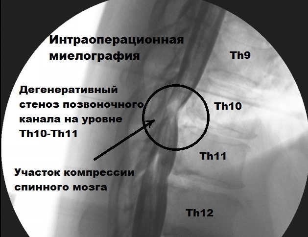 Диагностика стеноза при помощи миелографии