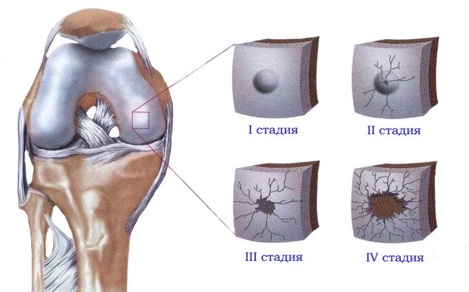 Степени разрушения при артрозе коленного сустава