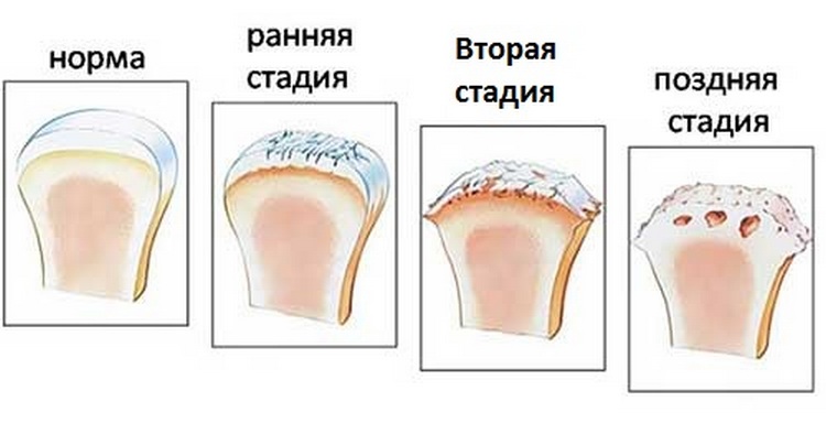 Степени разрушения при артрозе шеи