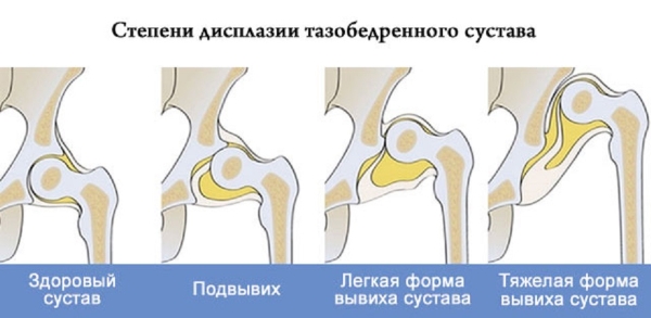 Степени дисплазии тазобедренного сустава