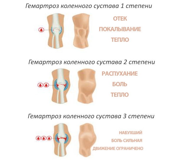 Степени гемартроза коленного сустава