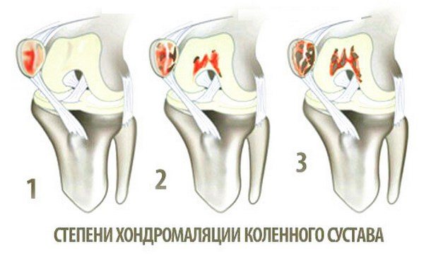 Степени хондромаляции
