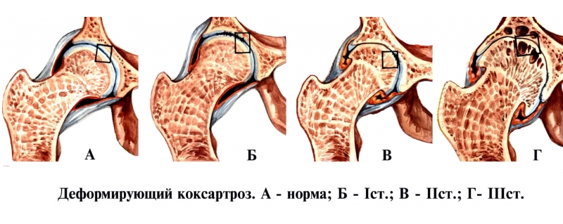 Степени коксартроза