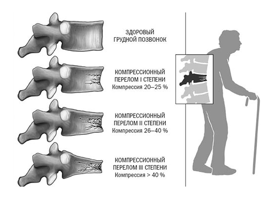 Степени компрессионного перелома