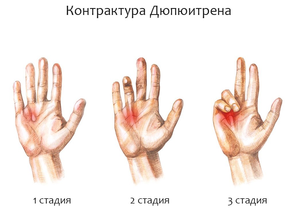 Степени контрактуры Дюпюитрена