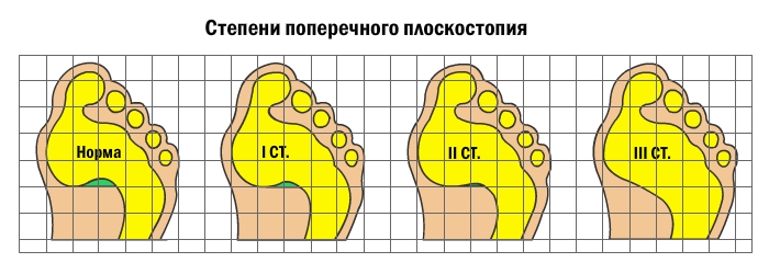 Степени поперечного плоскостопия