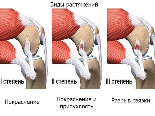 Степени растяжения плечевого сустава