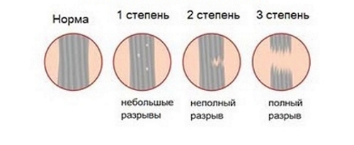 Степени растяжения и разрыва связок