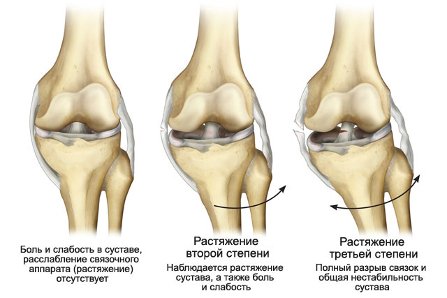 Степени разрыва связки колена