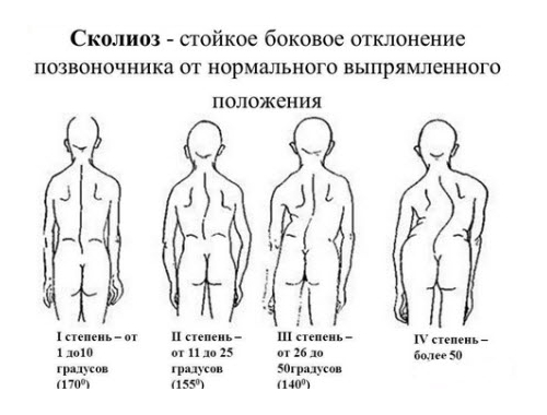 Степени искривления при сколиозе