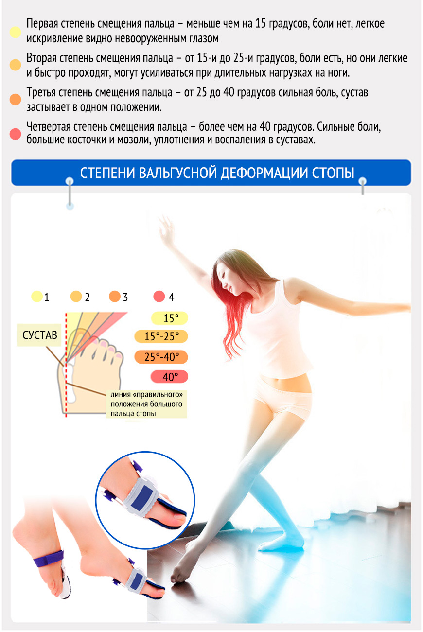 Степени вальгусной деформации большого пальца стопы