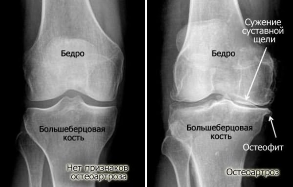 Сужение суставной щели на рентген снимке