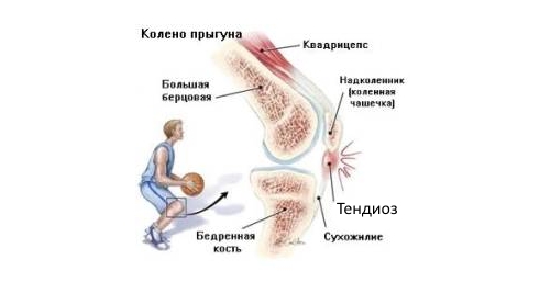 Тендиноз из-за перегрузок