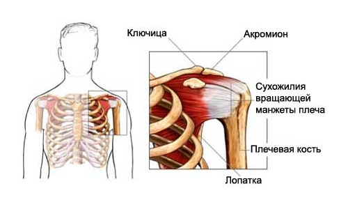 Тендиноз плечевого сустава
