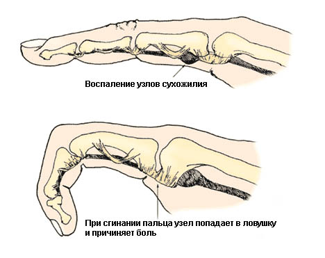 Тендосиновит