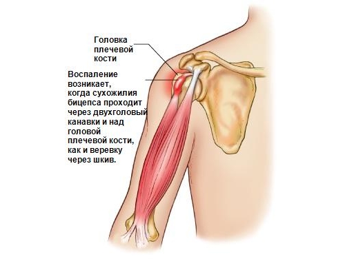 Теносиновит сухожилия длинной головки бицепса