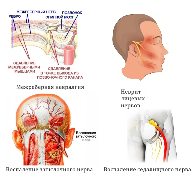 Частые зоны невралгии