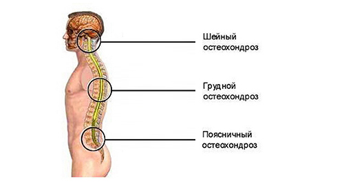 Типы остеохондроза