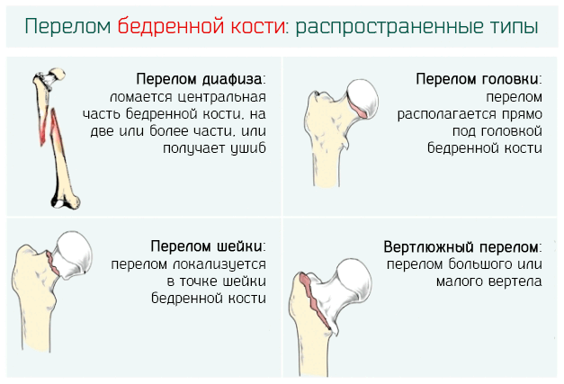 Общие типы переломов кости бедра